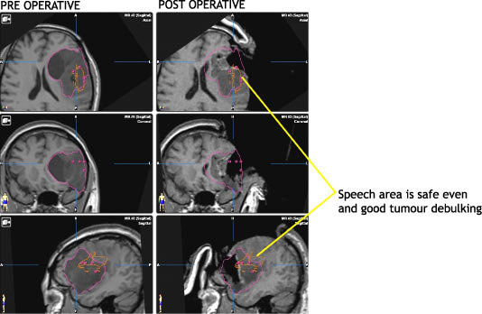 Pre Operative and Post Operative